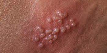 What is a venereal disease? Can venereal diseases be cured?
